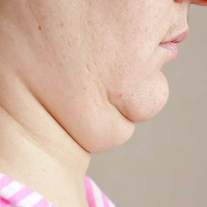 Flabby faces